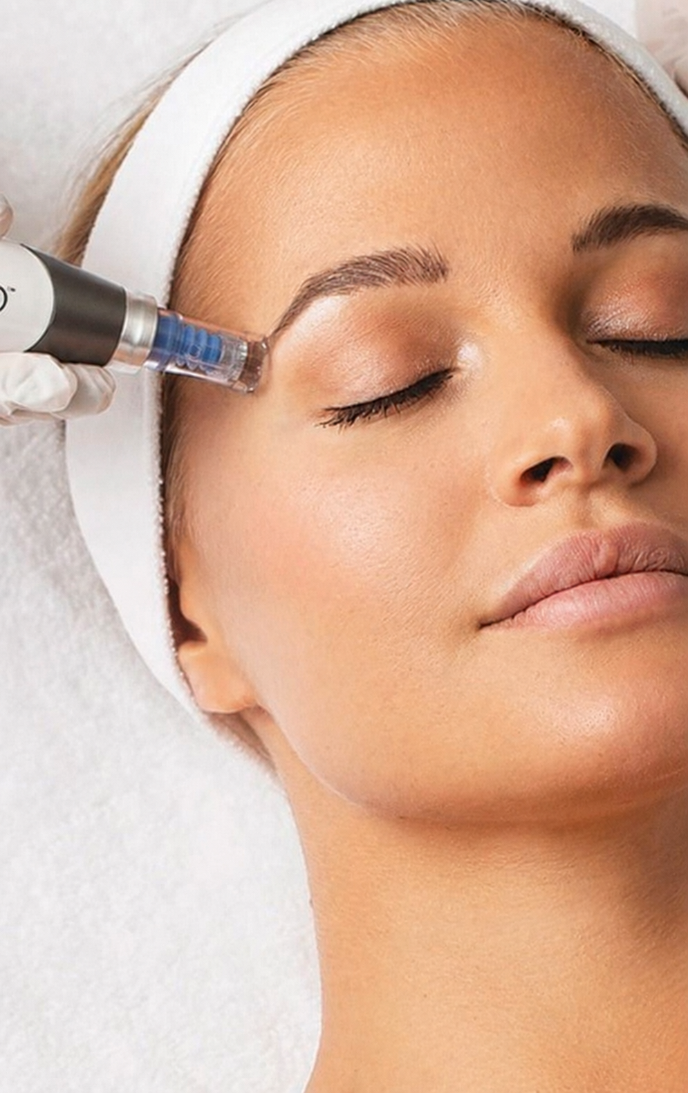 Microneedling
